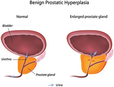 Adenomul de prostată | Uro-nefrologie | Ghid de boli